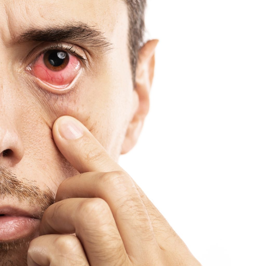 eye-bleeding-hyphema-causes-symptoms-and-treatment-sightconnection