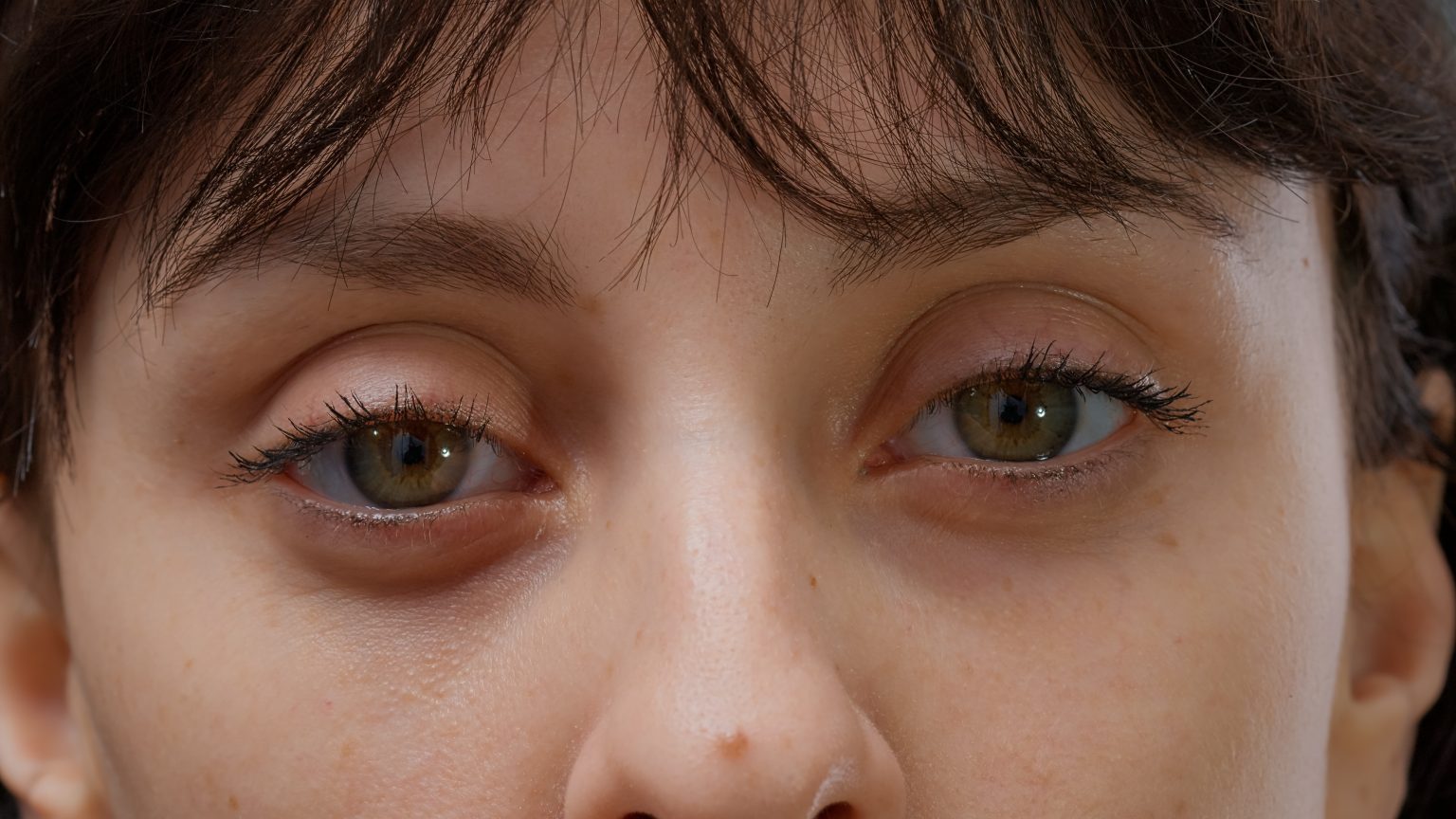 Eyelid Dermatitis: A Closer Look At Contact, Symptoms, And Treatment ...