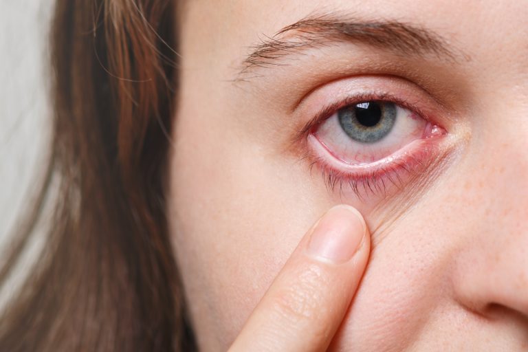 Pink Eyeconjunctivitis Causes Symptoms And Treatment Sightconnection 